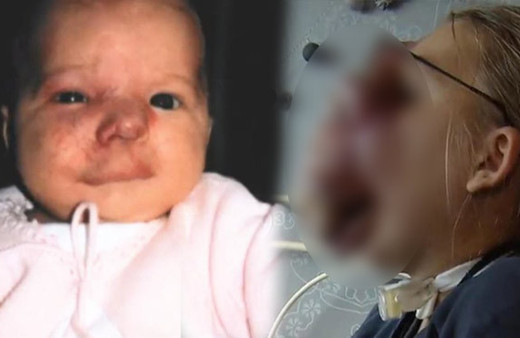 Küçük bir doğum lekesiyle doğdu 14 sene sonra bakın ne hale geldi!