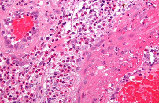 Vücutta meydana gelen yangı nedir tehlikeleri var mıdır?