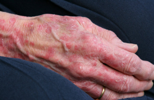 Cüzzam nedir 2018 yılında Türkiye'de iki kişide görüldü