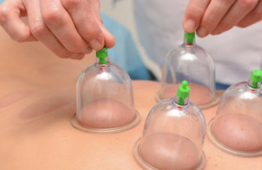 Hacamat nedir kimlere yapılır nasıl yapılır-hacamat faydalı mı? 