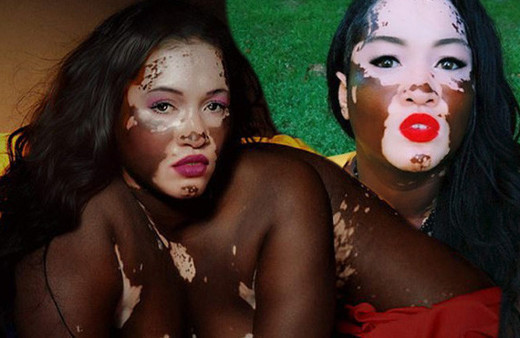 Vitiligolu model isyan etti! 'Ne yani böyleyim diye ölmem mi gerekiyor?'