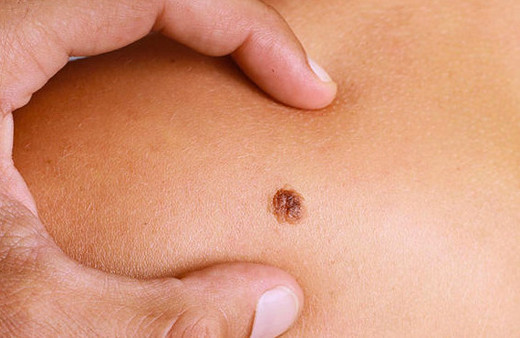 Deri kanserleri ve nevüslerde artık erken tanı mümkün