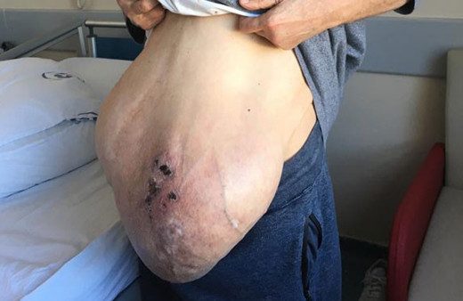 Fıtığı neredeyse yere değiyordu imdadına Türk doktorlar yetişti