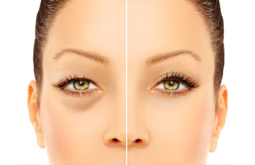 Torbalanmaları yok eden göz altı ışık dolgusunun zararları var mıdır 