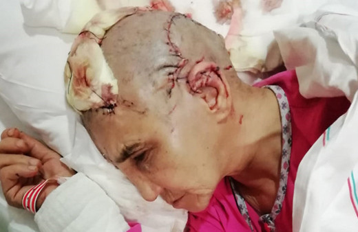 1 haftada 2 köpek saldırısı! Kadının kafa derisi 2 yerden koptu