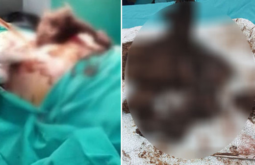 Ameliyatı yapan doktor şoke oldu! Midesinden çıkana bakın