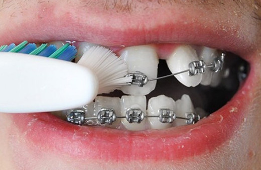 Diş teli olanlar dişlerine nasıl bakım yapmalıdır?