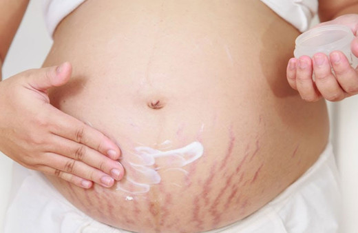 Hamilelik sonrası karın çatlaklarına dikkat edin