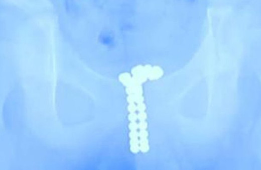 Penisinden çıkan şeyler şok etti! Tam 26 adet bakın nasıl içine girmiş