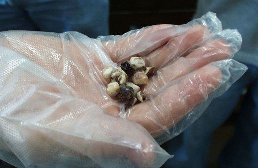 Bu hastalığa dikkat! Sarışınlarda daha çok görülüyor kanser riski bulunuyor