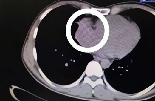 Yuttuğu kürdan kalbinden çıktı tıp dünyası şoka girdi! 