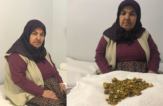 Şeker hastalığı için kontrole gitmişti! Midesinden çıkanlar şaşkına çevirdi