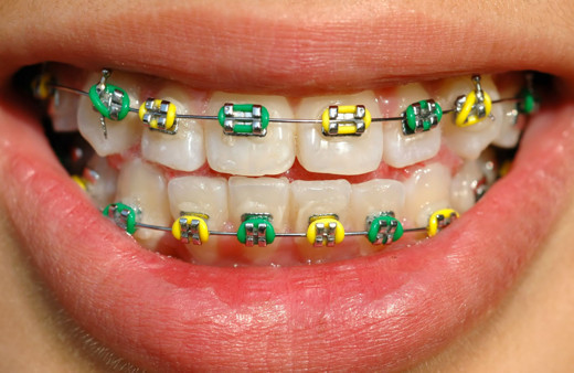 Diş teli takılırken acır mı? İşte merak edilen sorunun cevabı