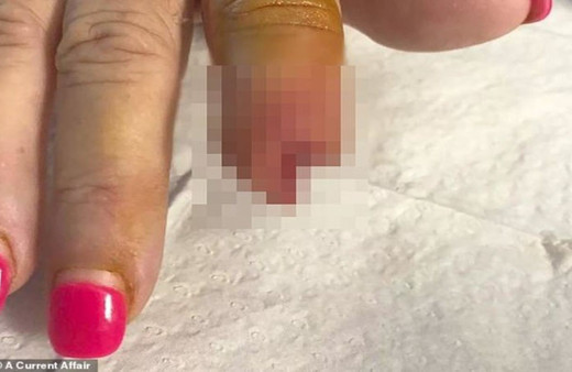 Güzelleşmek isterken parmağından oldu