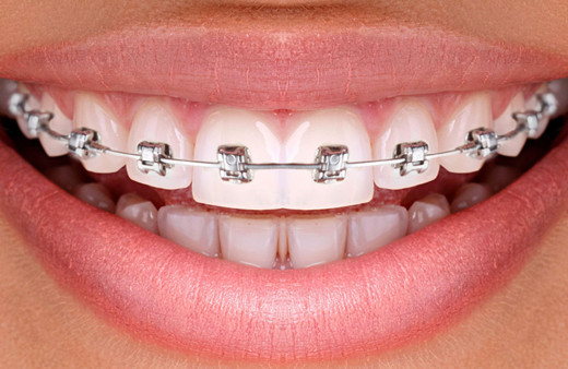 Diş telinin dudaklara bir zararı var mıdır?