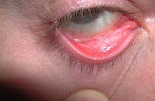 Kansızlık belirtileri nelerdir-anemi tedavisi