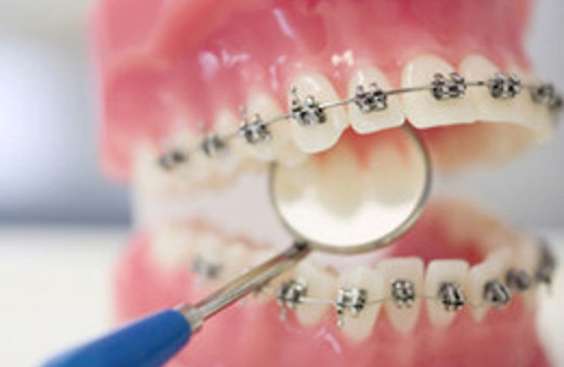 Diş teli kabusuna son