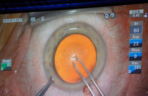 Türk doktor canlı yayında ameliyat yaptı!