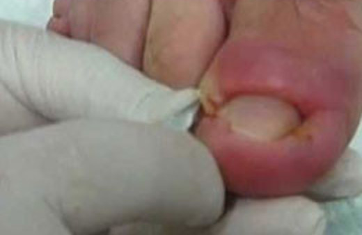 Tırnak çekime son!