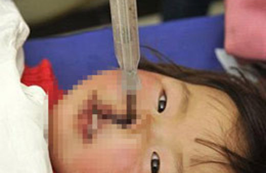 Burnuna tornavida saplandı