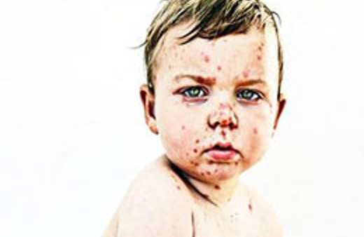 Kanser hastalarında su çiçeği alarmı!