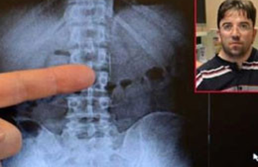 Kürdan yerine iğne kullandı ve...