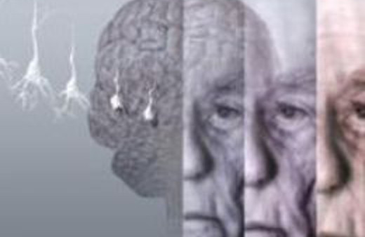 Alzheımer belirtileri ne zaman&nbsp;başlıyor?