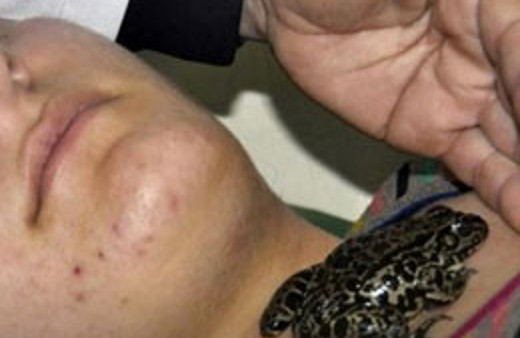 Guatr hastalarına kurbağalı tedavi