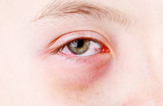 Kızarık göz bulaşıyor!