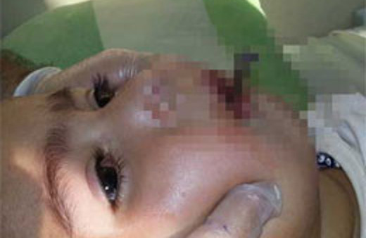 Ağzındaki çivi kafatasına saplandı