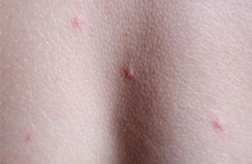 Yağ bezesi ne kadar tehlikeli?