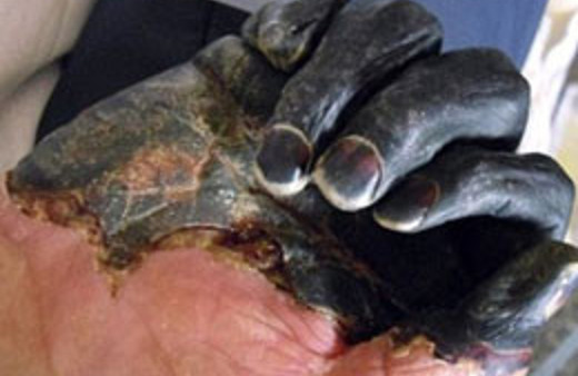 Kedi ısırığından veba kaptı TIKLA GÖR