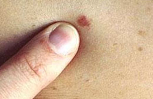 Vücunuzdaki benler kanser belirtisi olabilir