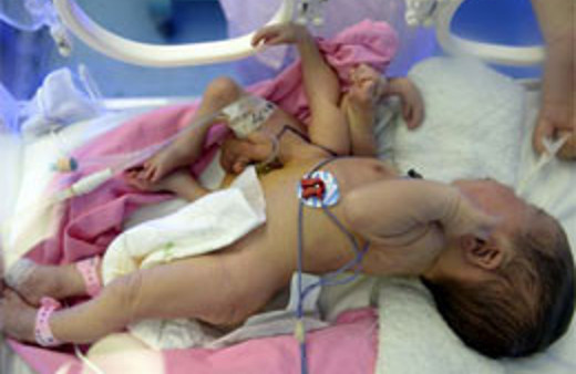 4 kollu ve 4 bacaklı bebek şoke etti