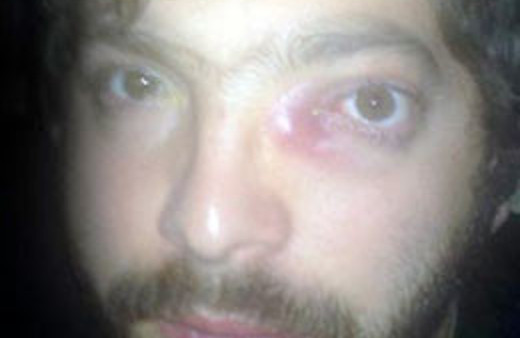 Gözündeki şişlik hayatını kararttı!