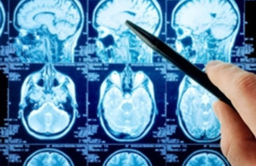 Beyninden portakal büyüklüğünde tümör çıktı!