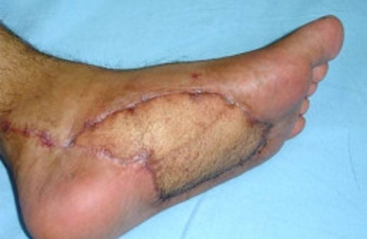 Yumuşak doku kanseri nedir? Kayahan'ın hastalığı