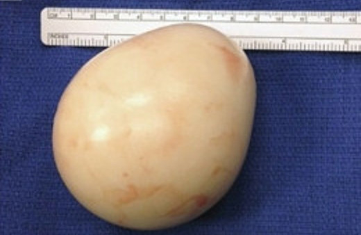 Karnından yarım kiloluk haşlanmış yumurta çıktı!