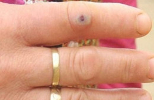 5 kişide rastlandı Giresun şokta