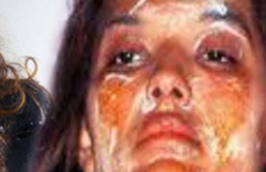 Demet Akalın'ın yüzü böyle yandı!