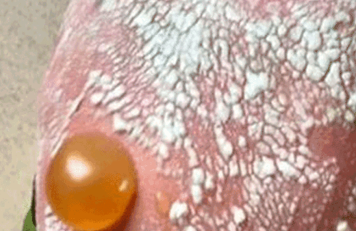 Böyle güneş yanığı görülmedi! Ağrısı dayanılmaz!