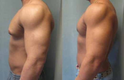 Erkeklerde meme büyümesine dikkat! 