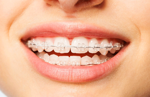 Diş teli neden takılır ne kadar süreyle dişte kalır?