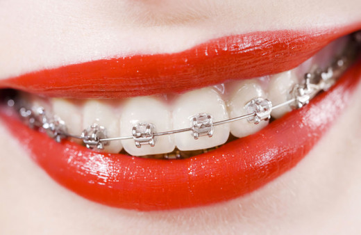 Diş teli kimlere takılır yaş sınırı var mıdır?