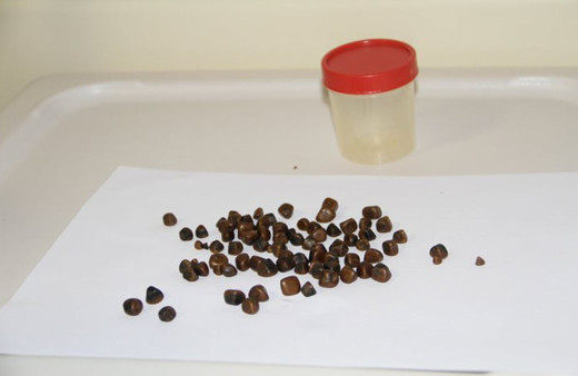 Antalya'da akılalmaz olay Ameliyatla çıkardılar tam 86 tane