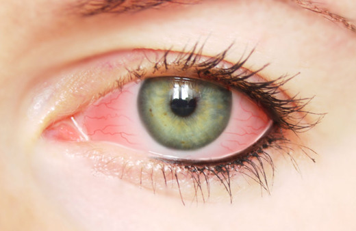 Kış aylarında göz nezlesi uyarısı! Tehlikesi var mıdır?