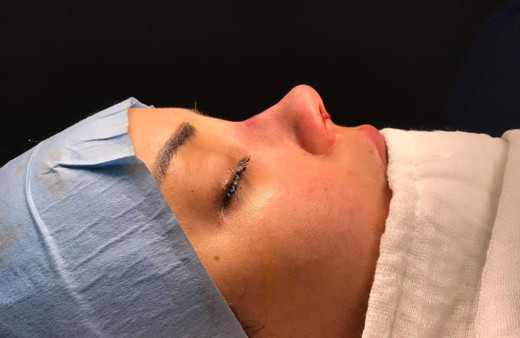 Burun için kemik şekillendirme işleminin tehlikesi var mıdır?