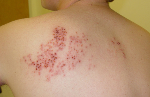 Zona (gece yanığı) hastalığı nedir uzmanlar uyarıyor