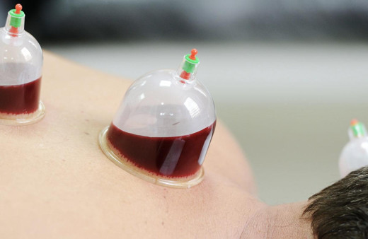 Hacamat günleri hangisi hangi günlerde yaptırılmaz?