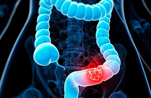 Kolon kanserinin en önemli belirtisi! Eğer yumurta akı gibi bir salgı varsa...
